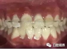 门牙撞了怎么办,门牙碎了你怎么办