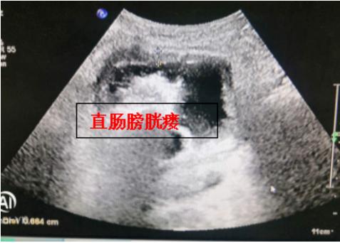 直肠癌晚期手术病例,直肠癌晚期多发性肠梗阻