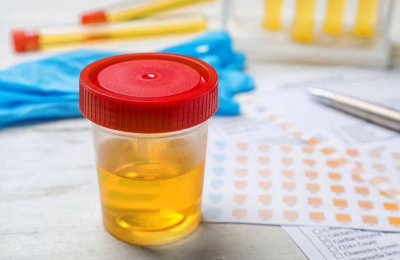 男子从不喝酒尿酸高,男子从不喝酒尿酸720引发肾衰竭