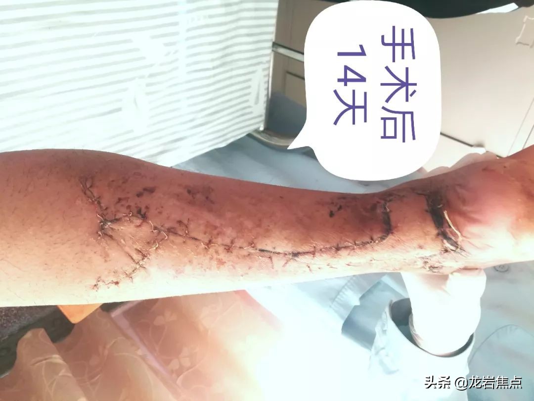 整块皮没了怎么处理,整块皮肤没了会增生吗