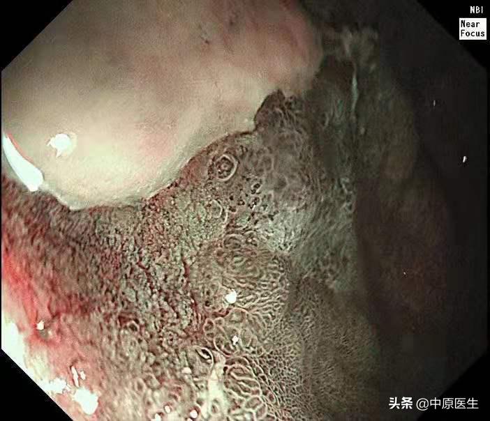 胃部怀疑是溃疡，细心专家又选择窄带光放大检查发现是胃癌