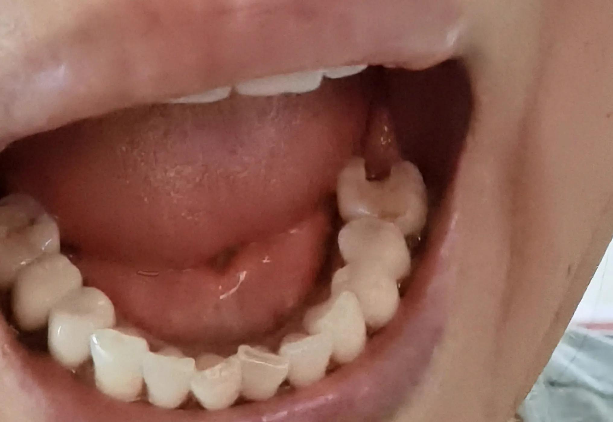 60后阿姨看牙经历：根管治疗后牙依然疼，持续一年不能用为什么？