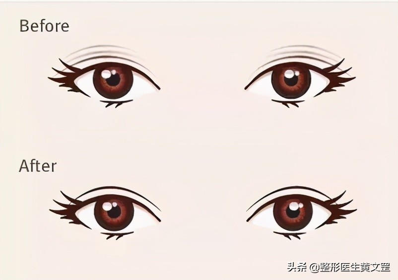 为什么眼皮一夜之间变成多层眼皮,怎么缓解多层眼皮