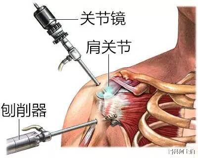 肩袖损伤要怎么处理,肩袖损伤专用膏药
