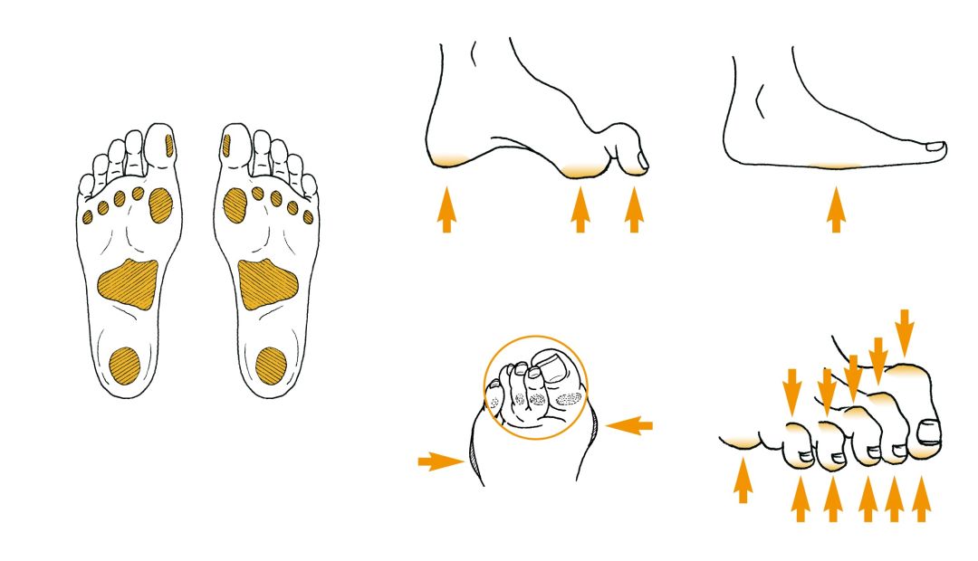 预防糖尿病足发生的正确方法,足部健康养生一切从脚开始