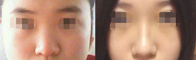 100个最关心的问题,隆鼻的十大问答