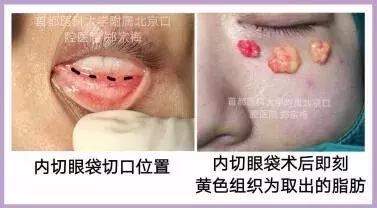 去眼袋最好的方法小红书,消除眼袋的护肤品安利