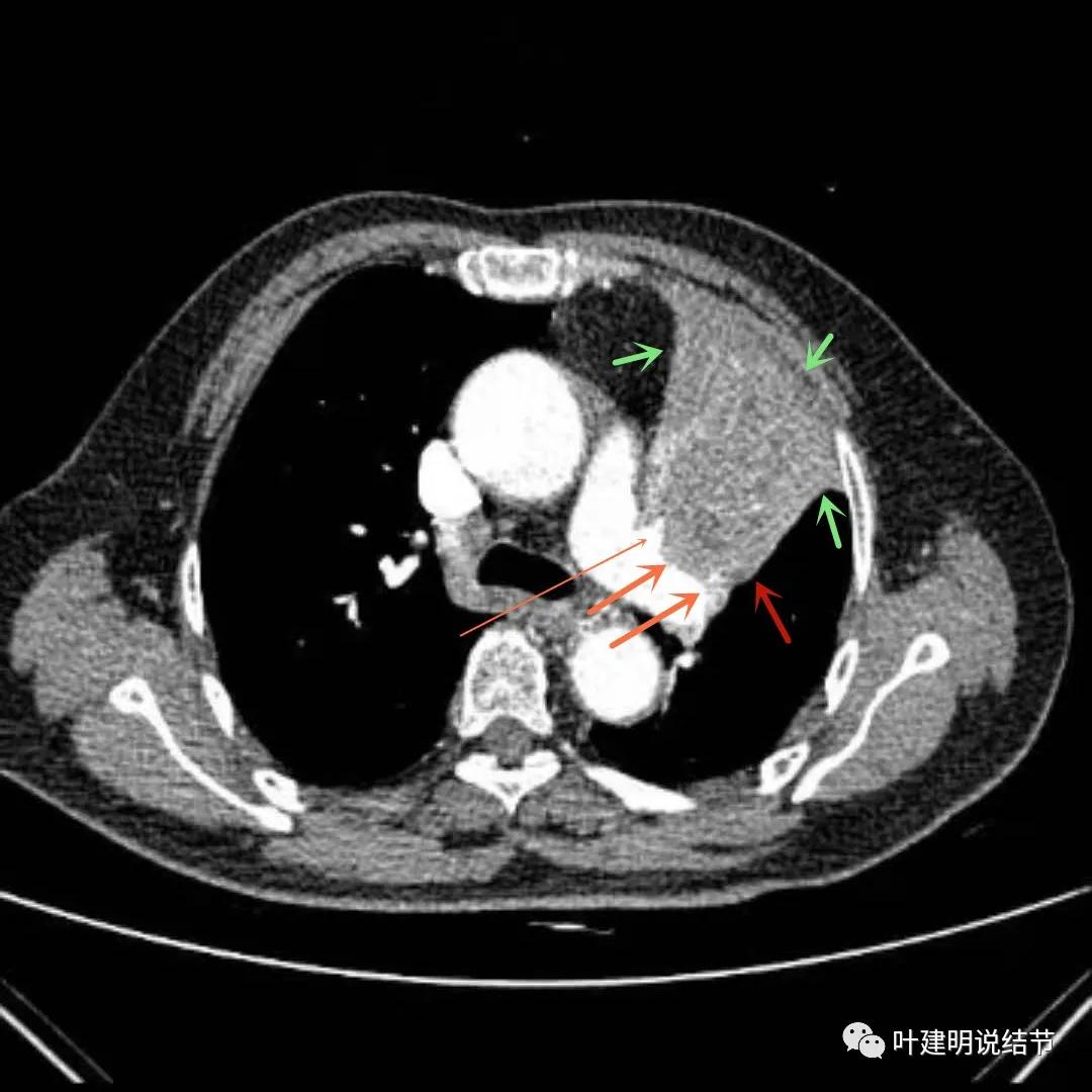 高龄肺癌靶向治疗效果,高龄老人肺癌早期适合放疗吗