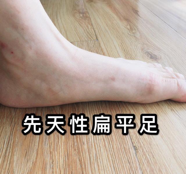 高弓足和扁平足穿的鞋一样吗,扁平足为什么要选平底鞋