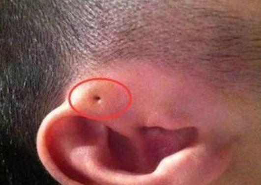 宝宝耳朵长了两个肉球想手术,小孩耳朵长肉疙瘩多大可以手术