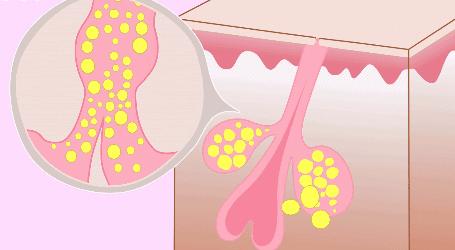 前胸后背长痘痘是毛囊炎吗,前胸后背很容易长痘痘中医治疗