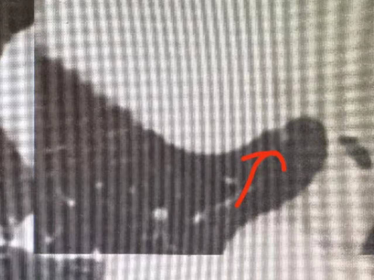 肺部罕见结节,两肺小结节什么意思