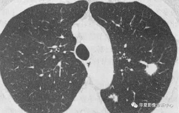 肺部代谢周期是多少天,肺部高代谢病变