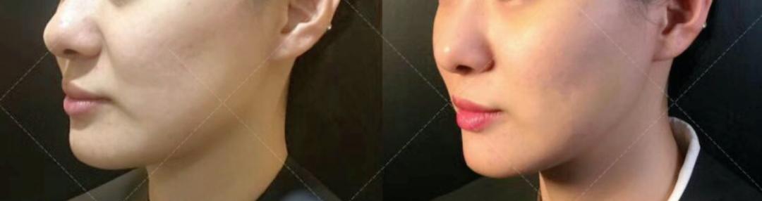 热玛吉法令纹消失了,热玛吉和fotona4d哪个法令纹效果好