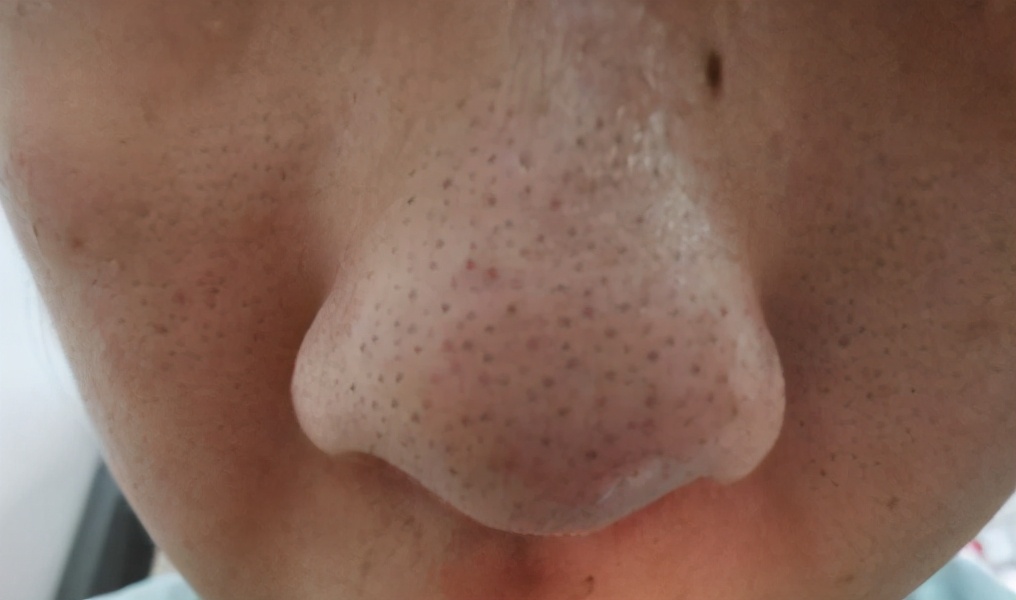 祛黑头一招搞定,祛黑头最好的办法是什么