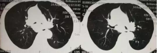 提醒｜烟龄40年肺鳞癌“找上门”，支气管镜下多种手段通畅气道
