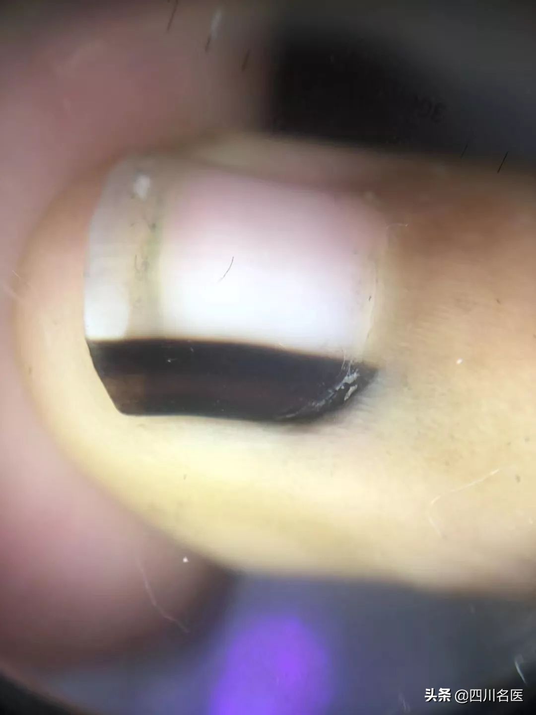 指甲有一毫米小段黑线是皮肤病,指甲上有黑竖线皮肤科