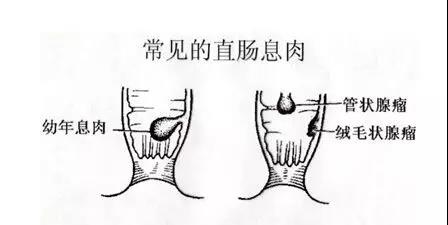 痔疮脱肛出血有肉球怎样消除,脱肛和痔疮肉球是一回事吗