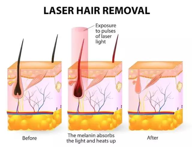 亲测5种脱毛方法，最最最最有效的居然是这一种？