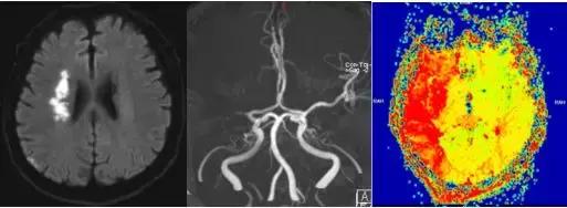 一人中风，全家“发疯”，脑梗5天，还能恢复吗？