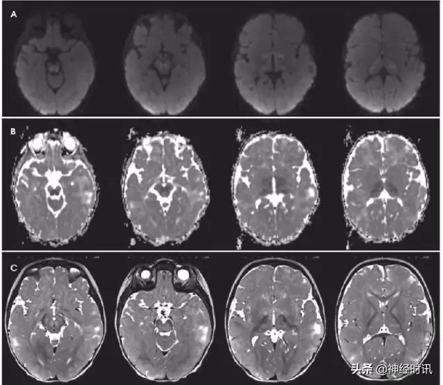 脑卒中的快速识别ppt,脑卒中神经影像学实例解析