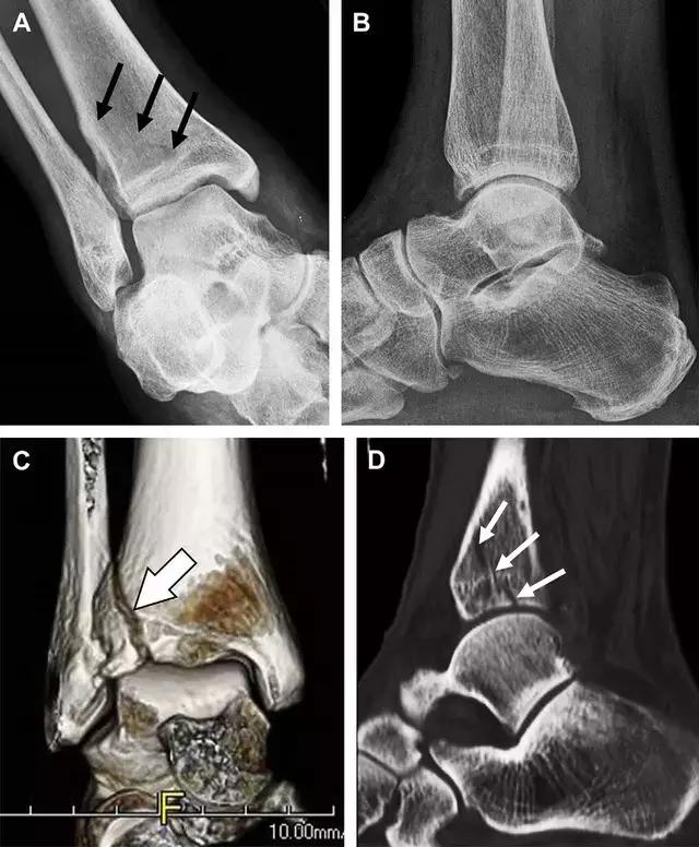 值夜班急救措施,放射科容易漏诊的骨折