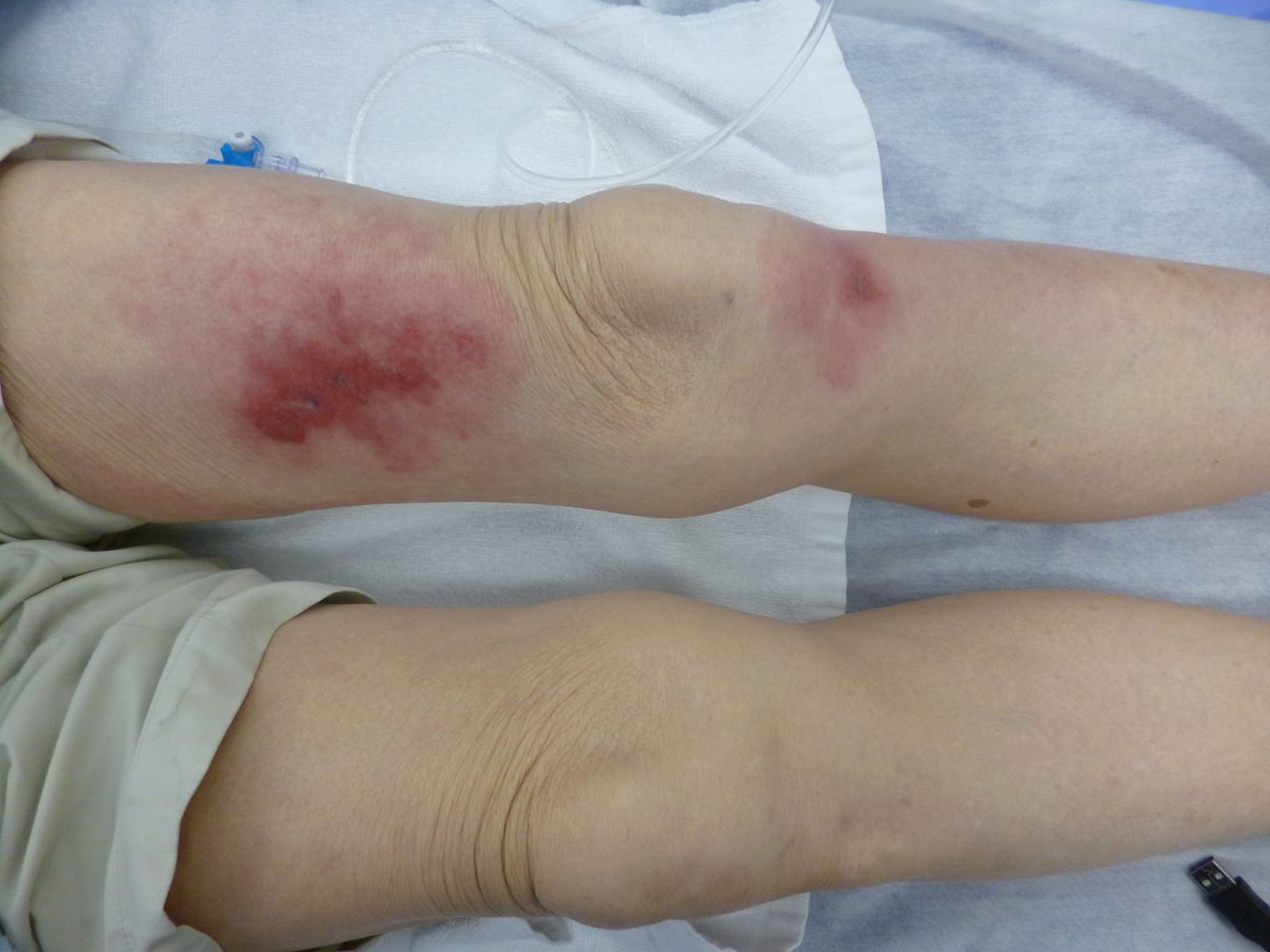 洗虾扎伤手老人被迫截肢保命,老人洗虾手指遭刺保命