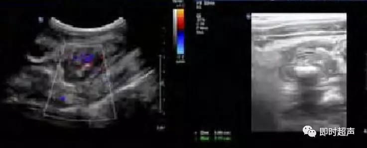 小儿消化道急症超声