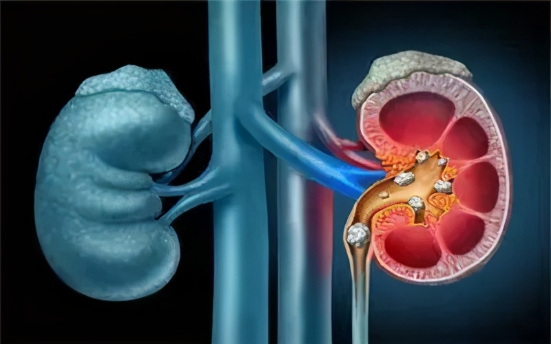 吃什么食物最容易导致肾结石,吃什么食物不容易得肾结石