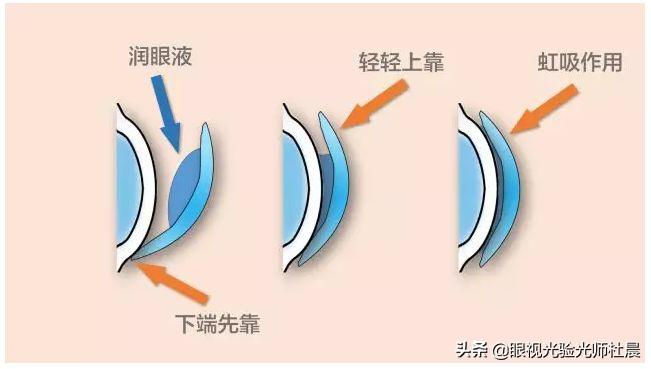 初次戴隐形眼镜有刺痛感,戴隐形眼镜时应注意哪些事项