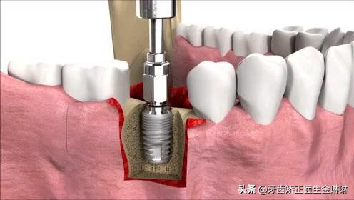 天津后槽牙种植一颗多少钱,后槽牙掉了四颗需要多少钱