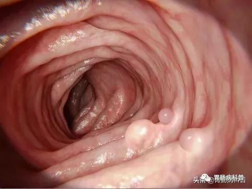 大便变细就是得了肠癌?医生说:不一定,还有这些可能