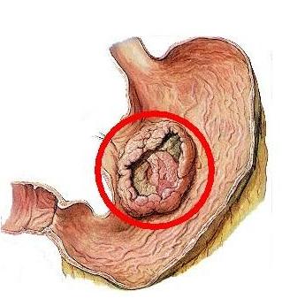 癌症会传染吗?医生说:一般是不会,但是这3种要区别对待