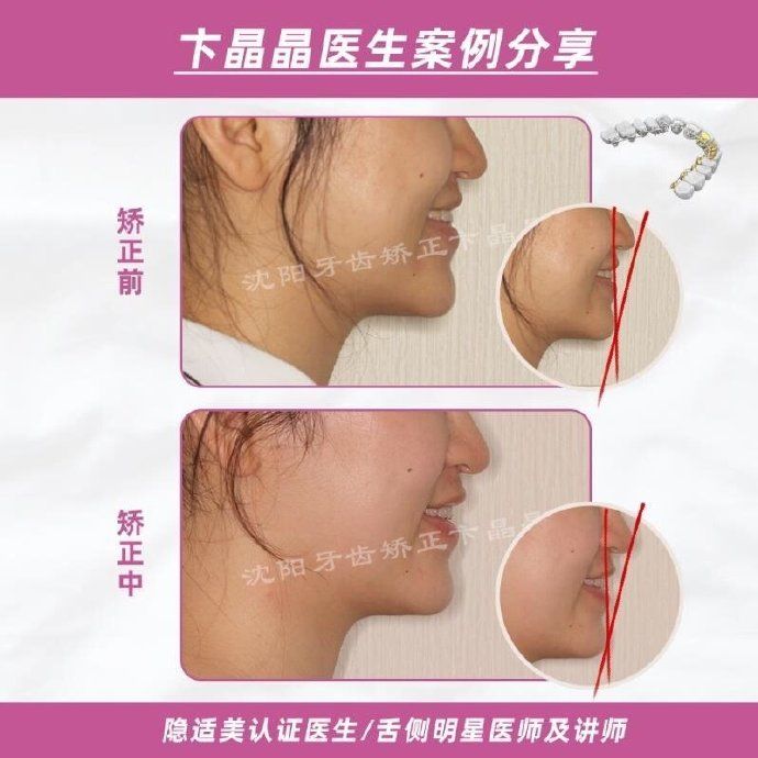 隐适美牙套矫正过程,隐适美个别牙反颌矫正真实案例