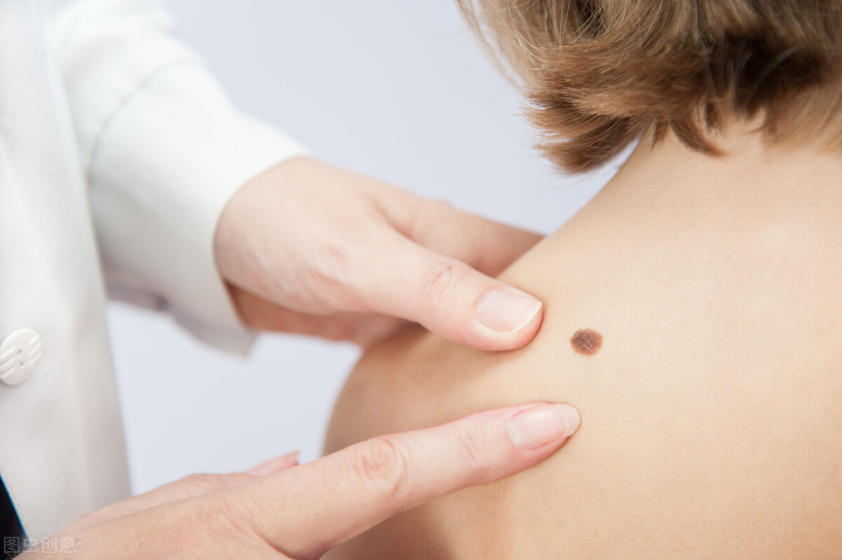 点痣后留疤了怎么办,点痣怕留疤抹什么药