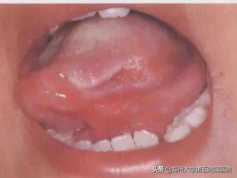 有一种痛叫口腔溃疡图片卡通,口腔溃疡痛用什么药