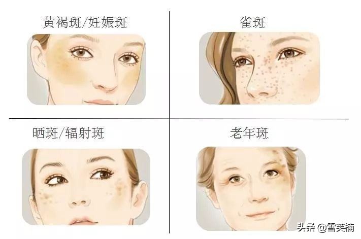 褐斑怎么去除最快最有效,褐斑用什么去除效果最好