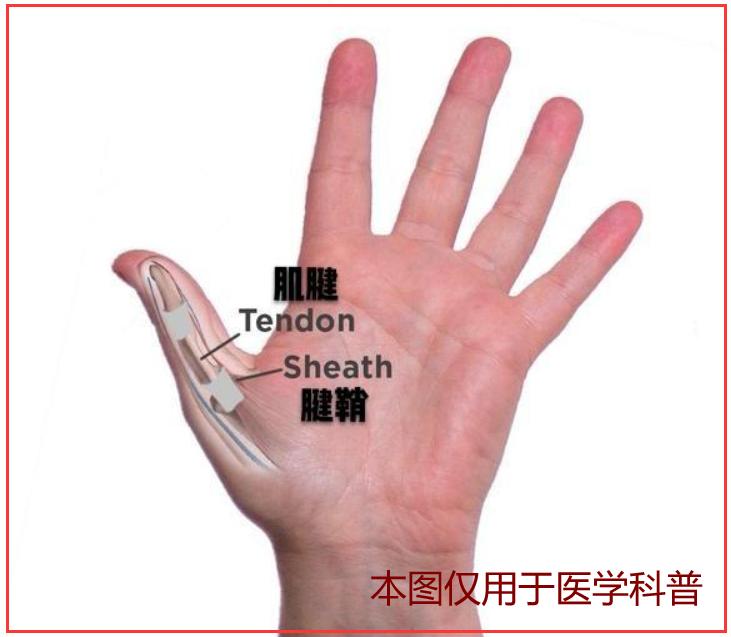 手指腱鞘炎怎么治好得快,手指有腱鞘炎怎么治才能好得快