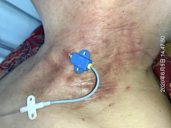 又见接触性皮炎？！不妨试试地塞米松+水胶体