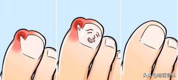 脚趾甲没扎到肉但是很痛怎么回事,脚指甲扎穿肉