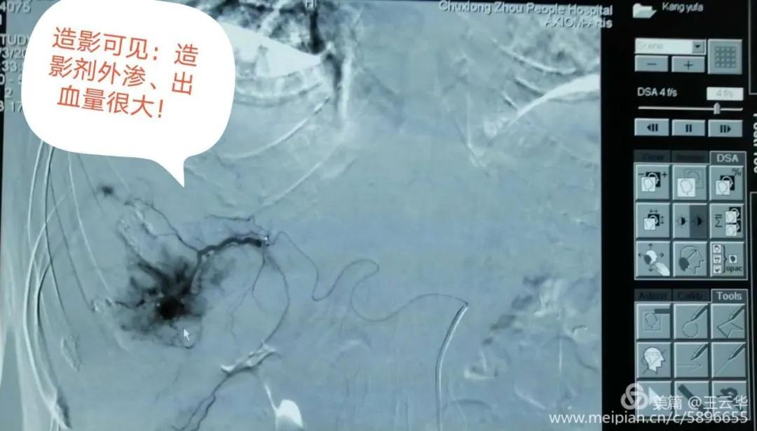 楚雄州人民医院肝胆外二科,四川省人民医院肝胆外科治疗肝癌