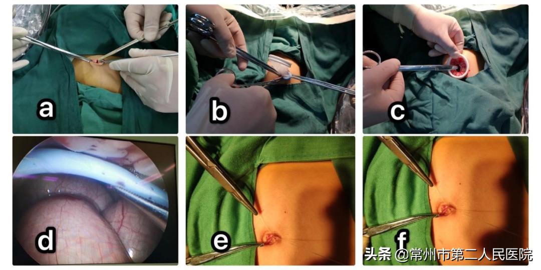 常州二院妇科：安全高效美丽无痕“微创”与“美容”完美结合