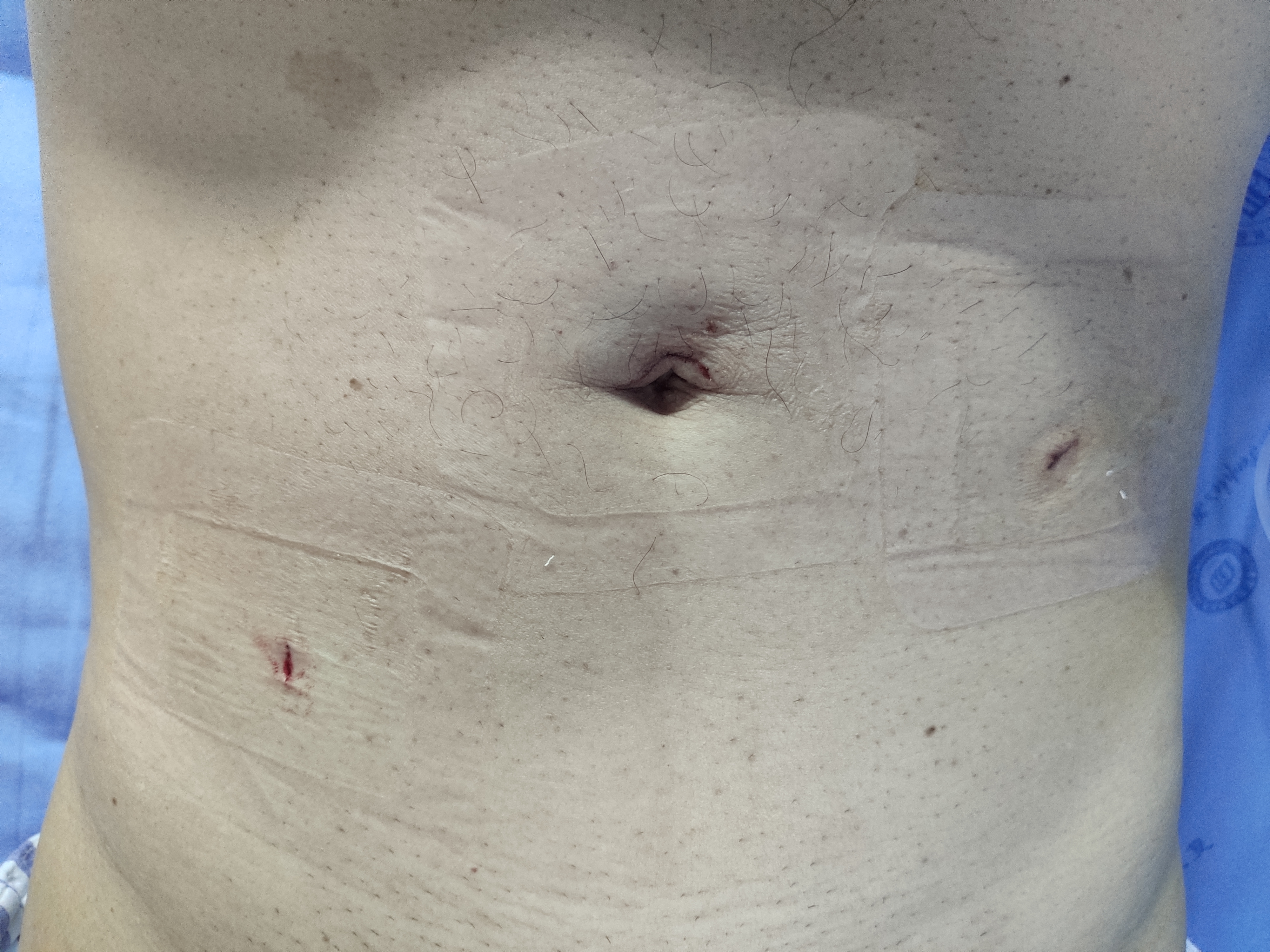 腹部凸显鸡蛋大包块，肿瘤？普外科微创搞定