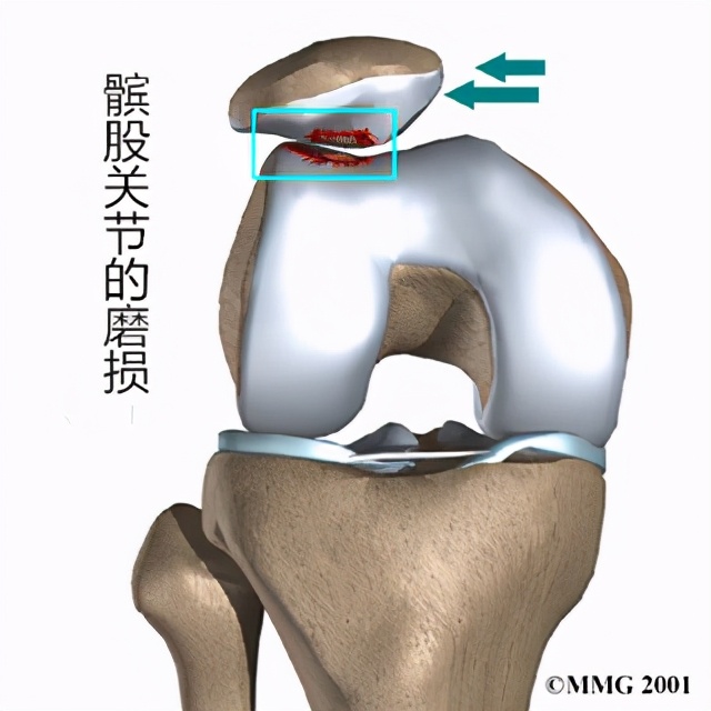 好久不活动一锻炼就膝盖疼,膝盖运动就疼休息就好