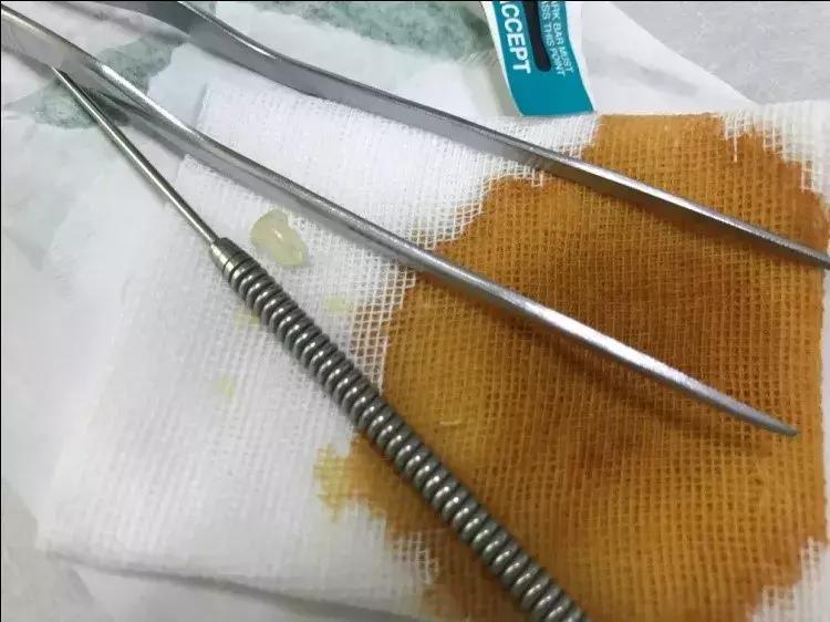 耳朵里长肉芽什么感觉,耳朵里长个小肉芽怎么办