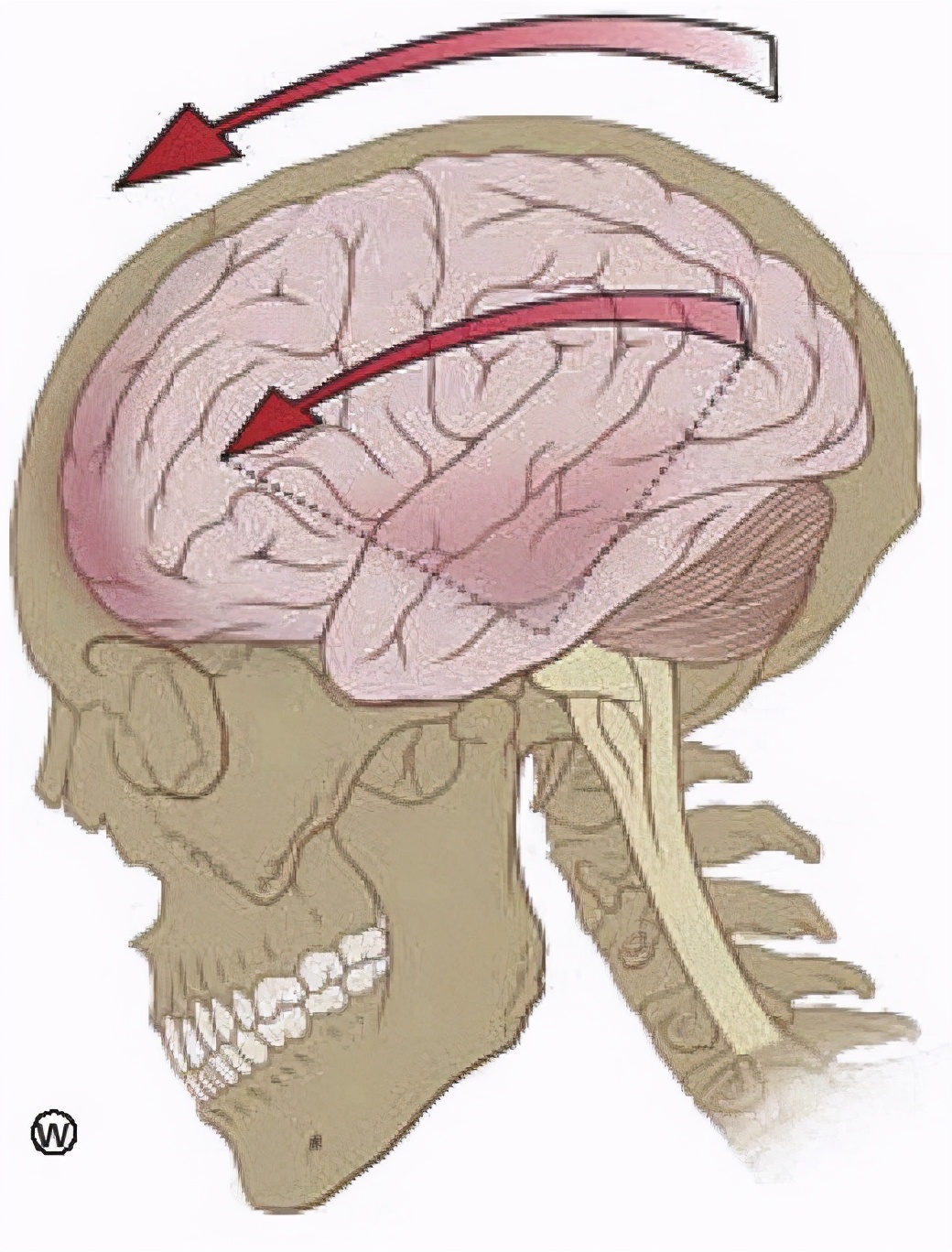 用头顶使劲撞墙会造成脑震荡么,自己用头撞墙会有脑震荡么