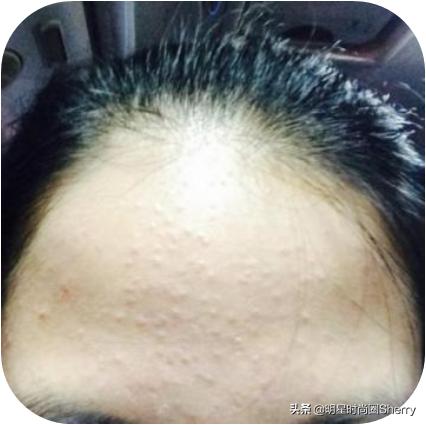 痘痘闭口粉刺去除的小妙招,痘痘粉刺闭口如何快速去除