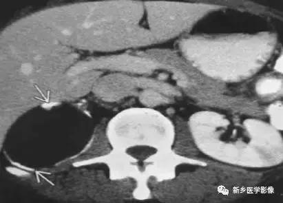 左肾可见高密度影不是结石,结节状高密度影是结石吗