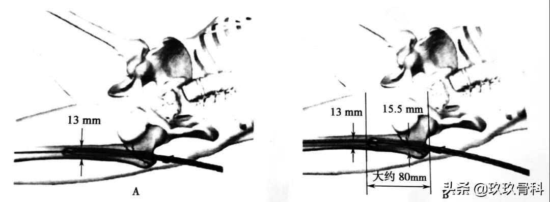 骨科用髓内钉什么材料,骨科髓内钉的作用