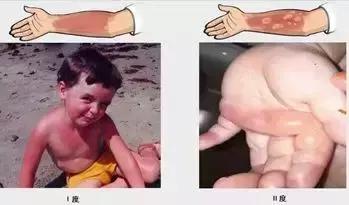 经常被烫伤割伤是犯了什么,烫烧伤怎么处理好得快